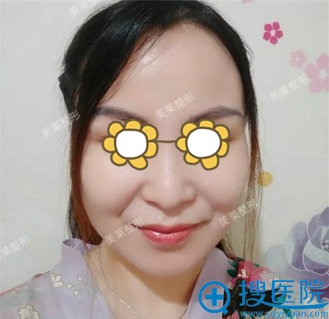 罗金超下颌角术后效果 罗金超下颌角术后效果