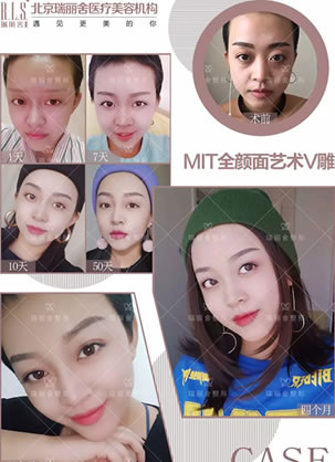 北京瑞丽舍整形马君怎样 看我找马尹主任做脂肪填充3个月效果