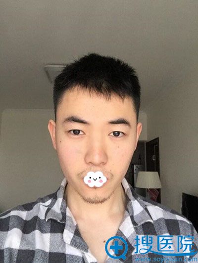 温州芘丽芙隆鼻效果好吗?朱富初为直男做鼻部假体综合整形案例