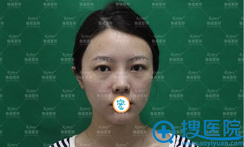 小美女在南宁韩成做假体+耳软骨垫鼻尖综合隆鼻术后真实反馈