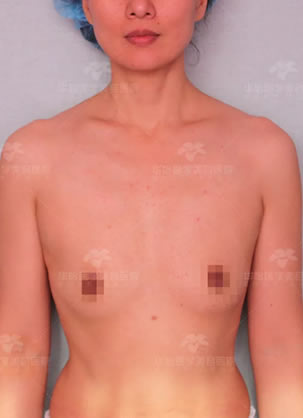 瞒着老公咨询烟台华美和华怡隆胸 华美张苹医生给做假体隆胸