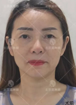 北京哪家医院做线雕好 45岁阿姨在北京莫琳娜做线雕过程和效果