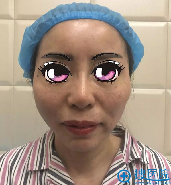 做完面部线雕手术即刻效果 做完面部线雕手术即刻效果
