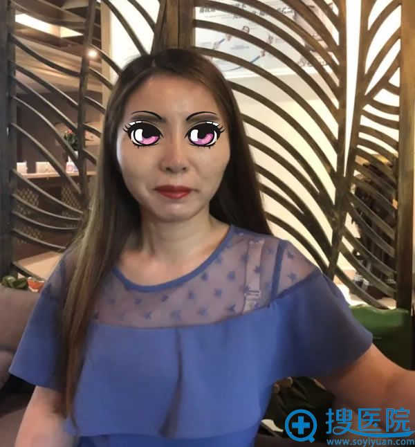 刚做完线雕手术4天的恢复照 刚做完线雕手术4天的恢复照