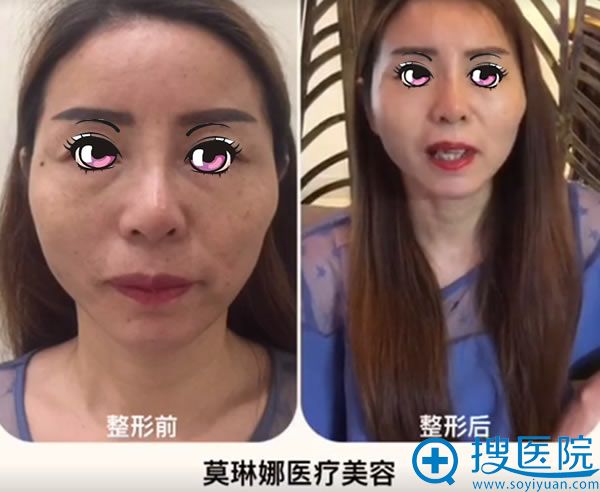 <!--<i data=20240710 data-id=12446></i>-->线雕真人案例对比图 <!--<i data=20240710 data-id=12446></i>-->线雕真人案例对比图