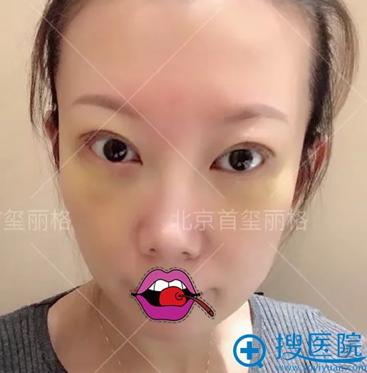 ��������˫��Ƥ+���۴�����7��Ч��