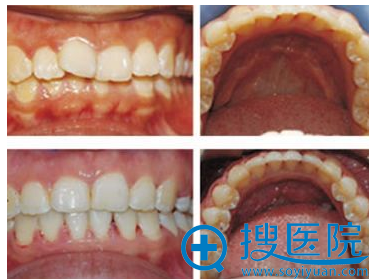 合肥壹加壹口腔医院牙齿矫正案例 合肥壹加壹口腔医院牙齿矫正案例