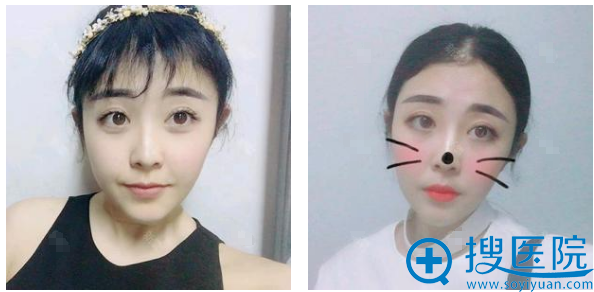 <!--<i data=20240710 data-id=12249></i>-->赵凌琪双眼皮案例一个月图片 <!--<i data=20240710 data-id=12249></i>-->赵凌琪双眼皮案例一个月图片