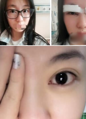 在发小推荐下我找北京美雅枫康虹院长做了开眼角和双眼皮手术