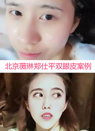 今天刚好是我找北京薇琳郑仕平院长做全切双眼皮手术后100天