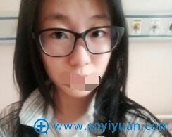 做双眼皮手术前的肿泡眼 做双眼皮手术前的肿泡眼