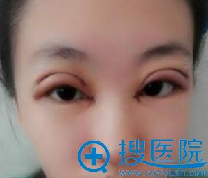 做完开眼角和双眼皮手术2天效果 做完开眼角和双眼皮手术2天效果