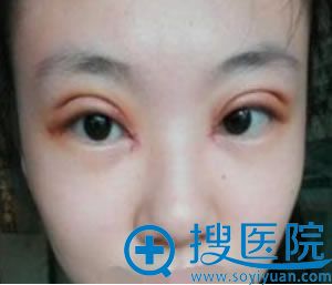 做完双眼皮后7天拆线效果 做完双眼皮后7天拆线效果