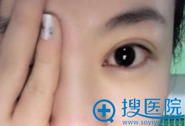 在美雅枫做完开眼角和双眼皮效果 在美雅枫做完开眼角和双眼皮效果