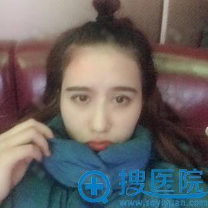 在薇琳做完双眼皮手术8天恢复照 在薇琳做完双眼皮手术8天恢复照