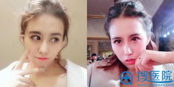 做完双眼皮手术第30天恢复效果 做完双眼皮手术第30天恢复效果
