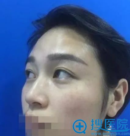 去丽都做双眼皮和鼻综合手术前 去丽都做双眼皮和鼻综合手术前