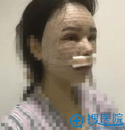 北京丽都做双眼皮和面部填充即刻图 北京丽都做双眼皮和面部填充即刻图