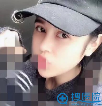 做双眼皮和鼻综合3个月恢复照 做双眼皮和鼻综合3个月恢复照