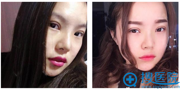 去上海华美找张朋主任做双眼皮隆鼻术后12天 去上海华美找张朋主任做双眼皮隆鼻术后12天