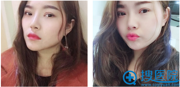 上海华美张朋做双眼皮怎么样?双眼皮案例2个月反馈 上海华美张朋做双眼皮怎么样?双眼皮案例2个月反馈
