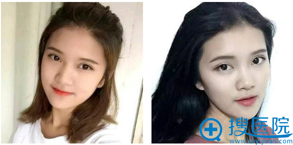 找乌鲁木齐华美整形医院李艳霞做完双眼皮5天了 找乌鲁木齐华美整形医院李艳霞做完双眼皮5天了