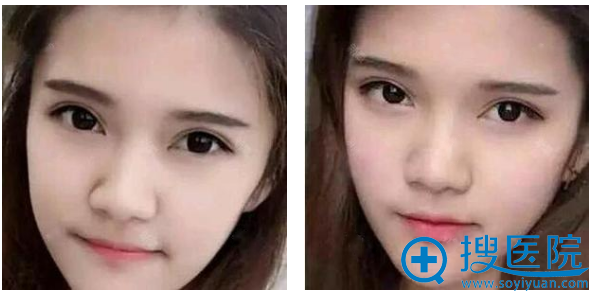 乌鲁木齐华美整形医院李艳霞双眼皮案例一个月效果图 乌鲁木齐华美整形医院李艳霞双眼皮案例一个月效果图