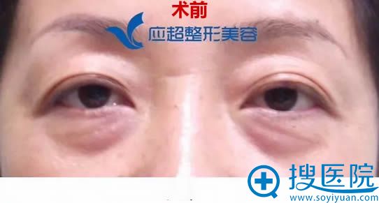 做去眼袋前的照片 做去眼袋前的照片