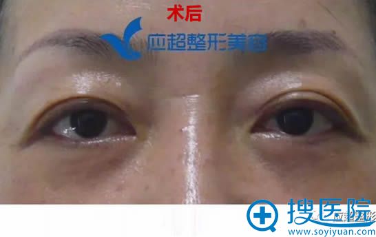 在<!--<i data=20240710 data-id=9063></i>-->让大吴做完祛眼袋15天恢复效果 在<!--<i data=20240710 data-id=9063></i>-->让大吴做完祛眼袋15天恢复效果