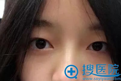 到无锡施尔美做双眼皮手术前 到无锡施尔美做双眼皮手术前