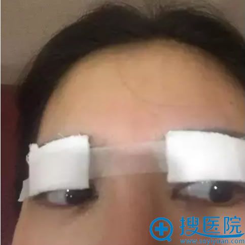 在无锡施尔美刚做完双眼皮照片 在无锡施尔美刚做完双眼皮照片