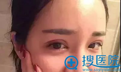 在施尔美做完双眼皮3天恢复照 在施尔美做完双眼皮3天恢复照