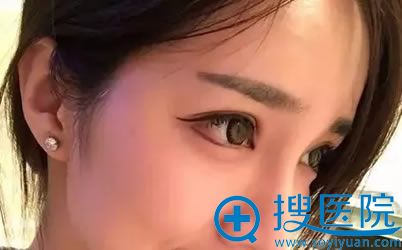 割完双眼皮手术10天恢复图片 割完双眼皮手术10天恢复图片