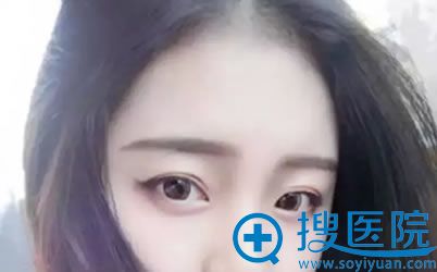 无锡施尔美吕院长双眼皮案例 无锡施尔美吕院长双眼皮案例