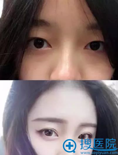 无锡施尔美吕韩伟院长双眼皮案例对比图 无锡施尔美吕韩伟院长双眼皮案例对比图