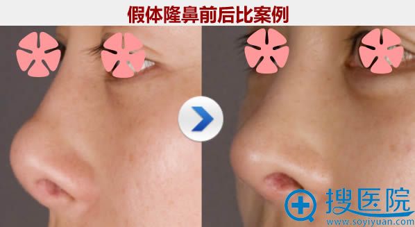 朱文政假体隆鼻案例图 朱文政假体隆鼻案例图