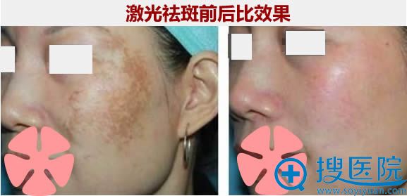 张永琳激光祛斑前后比效果 张永琳激光祛斑前后比效果