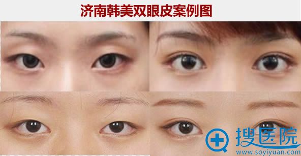 <!--<i data=20240710 data-id=12744></i>-->双眼皮案例及前后对比效果 <!--<i data=20240710 data-id=12744></i>-->双眼皮案例及前后对比效果