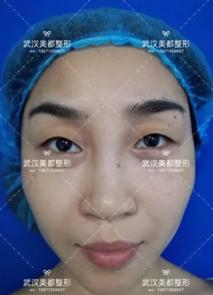 做完开眼角和双眼皮后才知道为啥武汉美都整形张召院长口碑好