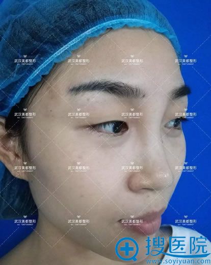 找美都<!--<i data=20240710 data-id=15873></i>-->做双眼皮手术前照片 找美都<!--<i data=20240710 data-id=15873></i>-->做双眼皮手术前照片