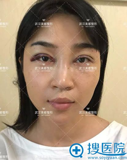 <!--<i data=20240710 data-id=9793></i>--><!--<i data=20240710 data-id=15873></i>-->双眼皮案例即刻效果 <!--<i data=20240710 data-id=9793></i>--><!--<i data=20240710 data-id=15873></i>-->双眼皮案例即刻效果