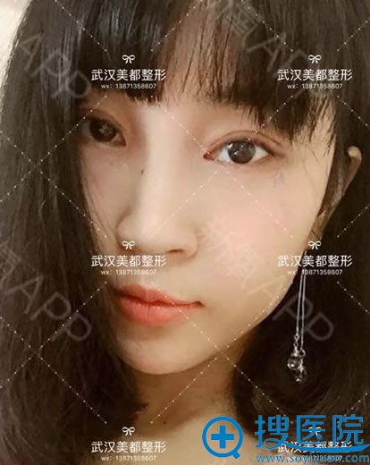 做完开眼角和双眼皮手术2个月后 做完开眼角和双眼皮手术2个月后