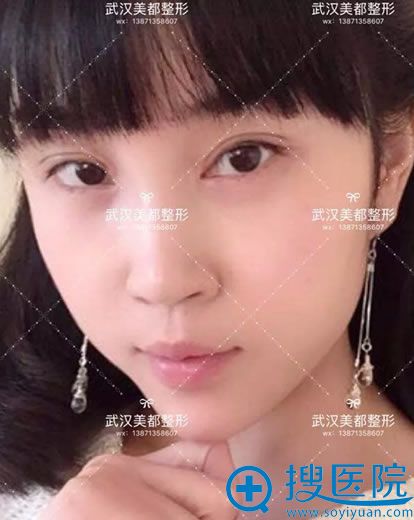 美都<!--<i data=20240710 data-id=15873></i>-->开眼角和双眼皮案例 美都<!--<i data=20240710 data-id=15873></i>-->开眼角和双眼皮案例