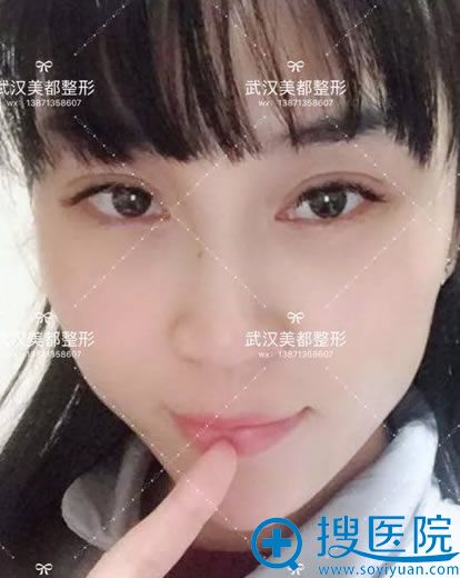 <!--<i data=20240710 data-id=9793></i>-->开眼角和双眼皮恢复过程图 <!--<i data=20240710 data-id=9793></i>-->开眼角和双眼皮恢复过程图