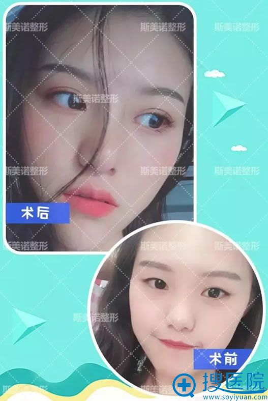 ����˹��ŵ���ɻ�ҽ��˫��Ƥ����