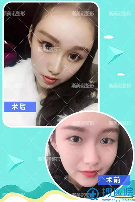 ����˹��ŵ�ܽ�ҽ��˫��Ƥ����