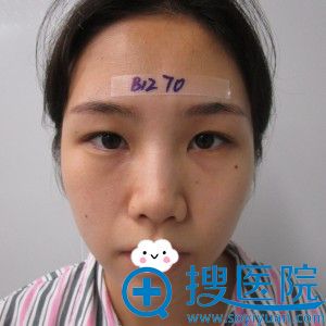 为了让自己有个美丽余生到成都素美李朝鹏处做膨体隆鼻了!