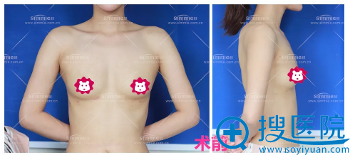事实证明上海喜美除了双眼皮隆鼻手术外假体隆胸做的也不错哦