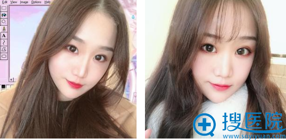 找上海美莱整形医院的吴海龙医生做完双眼皮整整100天了 找上海美莱整形医院的吴海龙医生做完双眼皮整整100天了