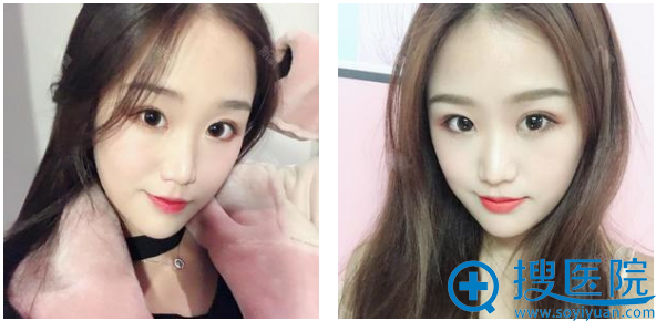 上海美莱整形医院的吴海龙医生做的双眼皮案例术后三个月图片 上海美莱整形医院的吴海龙医生做的双眼皮案例术后三个月图片